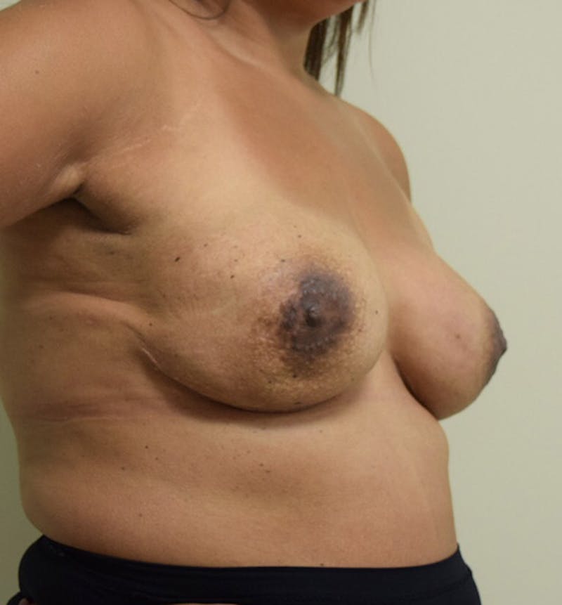 Breast Reconstruction Before & After Gallery - Patient 102567034 - Image 4