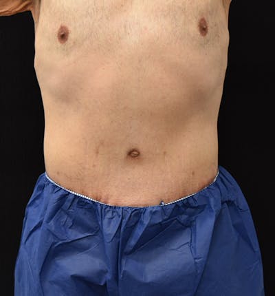 Male Lower Body Lift Before & After Gallery - Patient 148037530 - Image 2