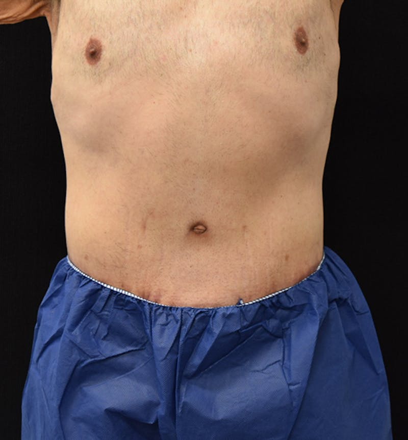 Male Lower Body Lift Before & After Gallery - Patient 148037530 - Image 2