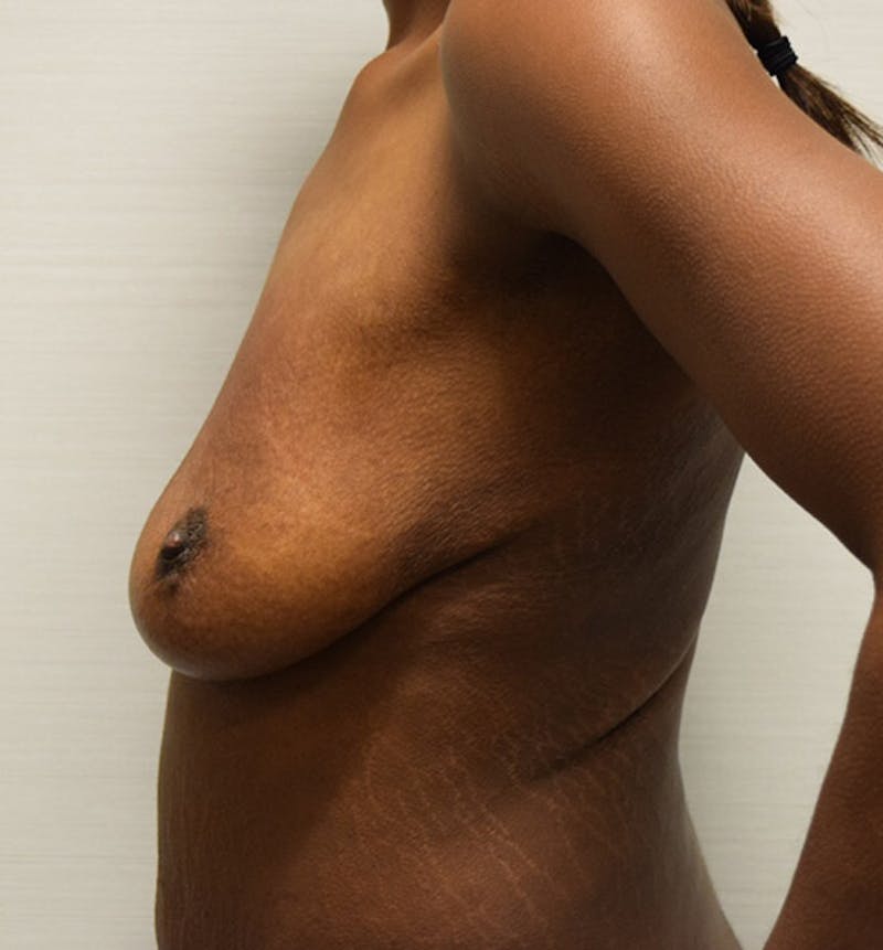 Breast Lift Gallery - Patient 102567032 - Image 5