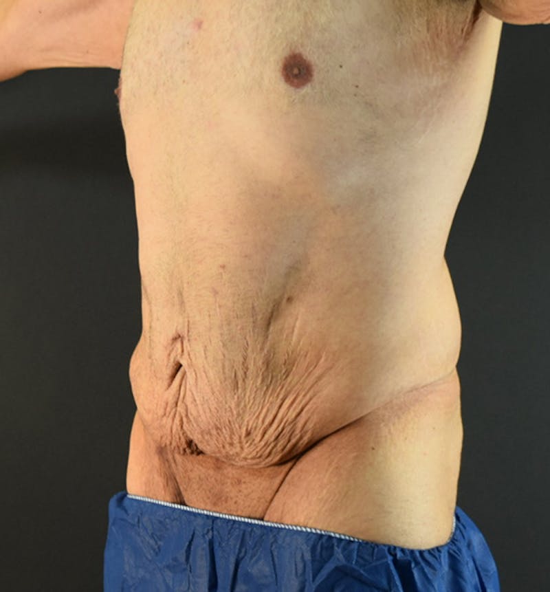 Lower Body Lift Before & After Gallery - Patient 148037530 - Image 3