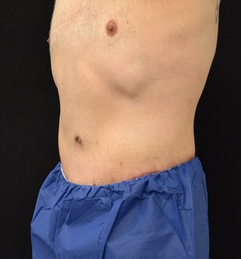 Lower Body Lift Before & After Gallery - Patient 148037530 - Image 4