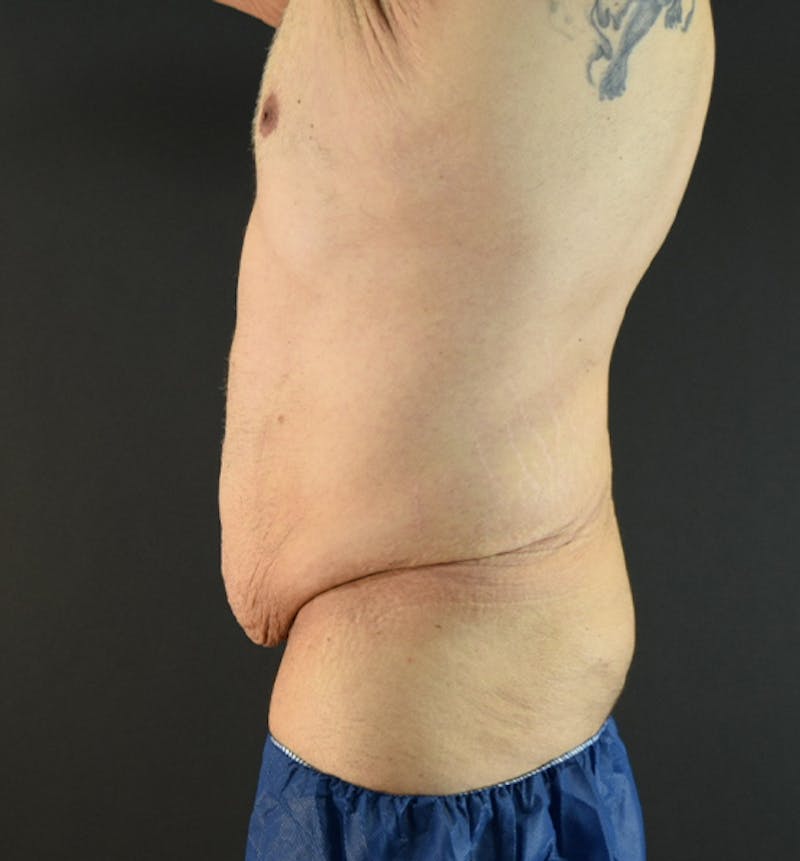 Male Lower Body Lift Before & After Gallery - Patient 148037530 - Image 5
