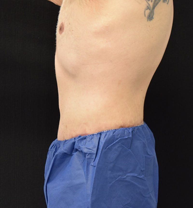 Male Lower Body Lift Before & After Gallery - Patient 148037530 - Image 6
