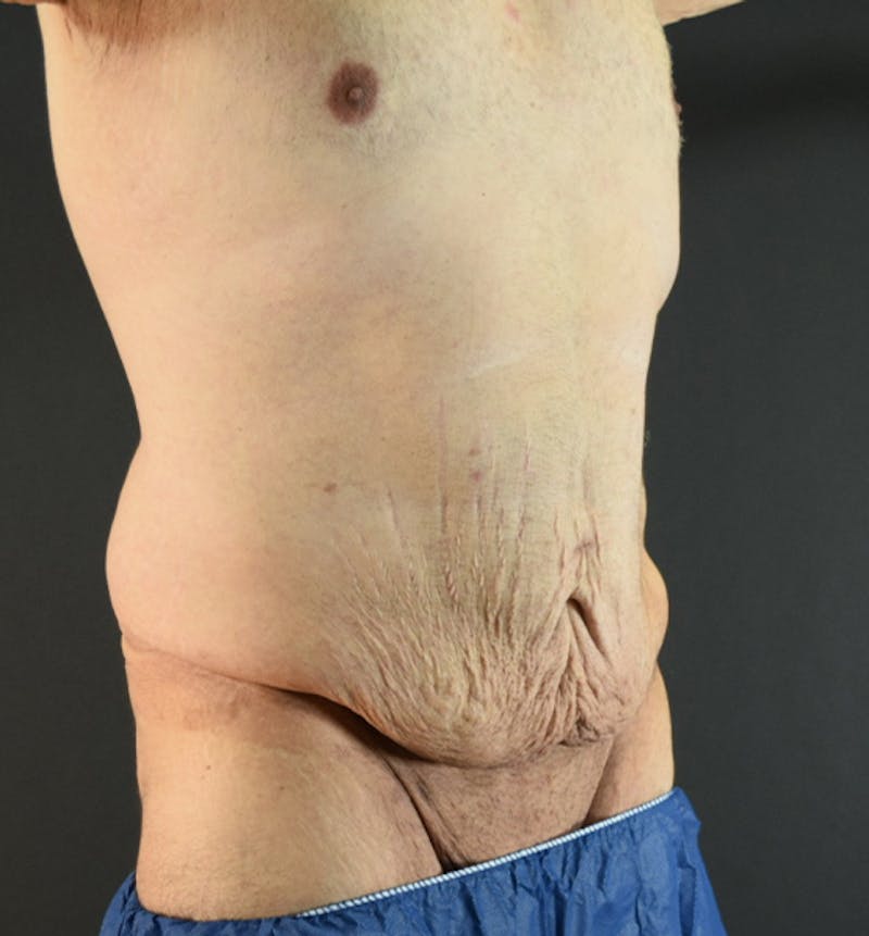 Male Lower Body Lift Before & After Gallery - Patient 148037530 - Image 7