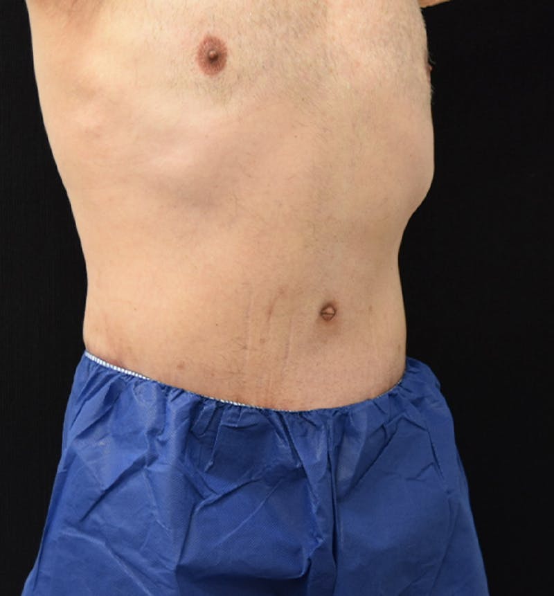 Male Lower Body Lift Before & After Gallery - Patient 148037530 - Image 8
