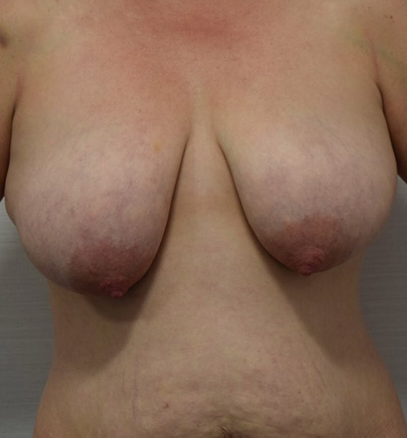 Breast Lift Before & After Gallery - Patient 102567038 - Image 1