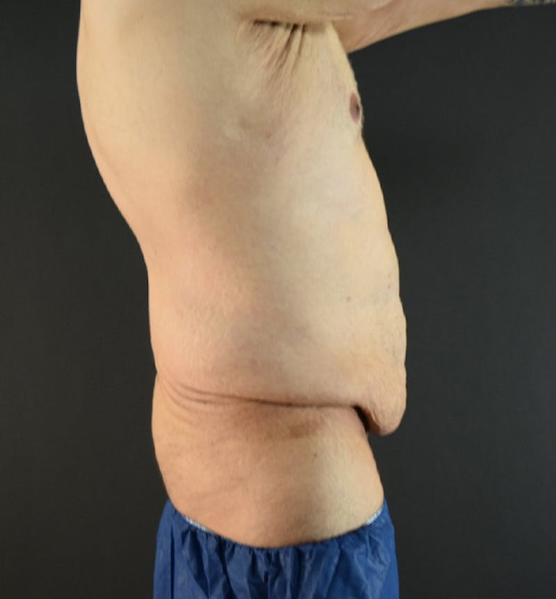 Male Lower Body Lift Before & After Gallery - Patient 148037530 - Image 9