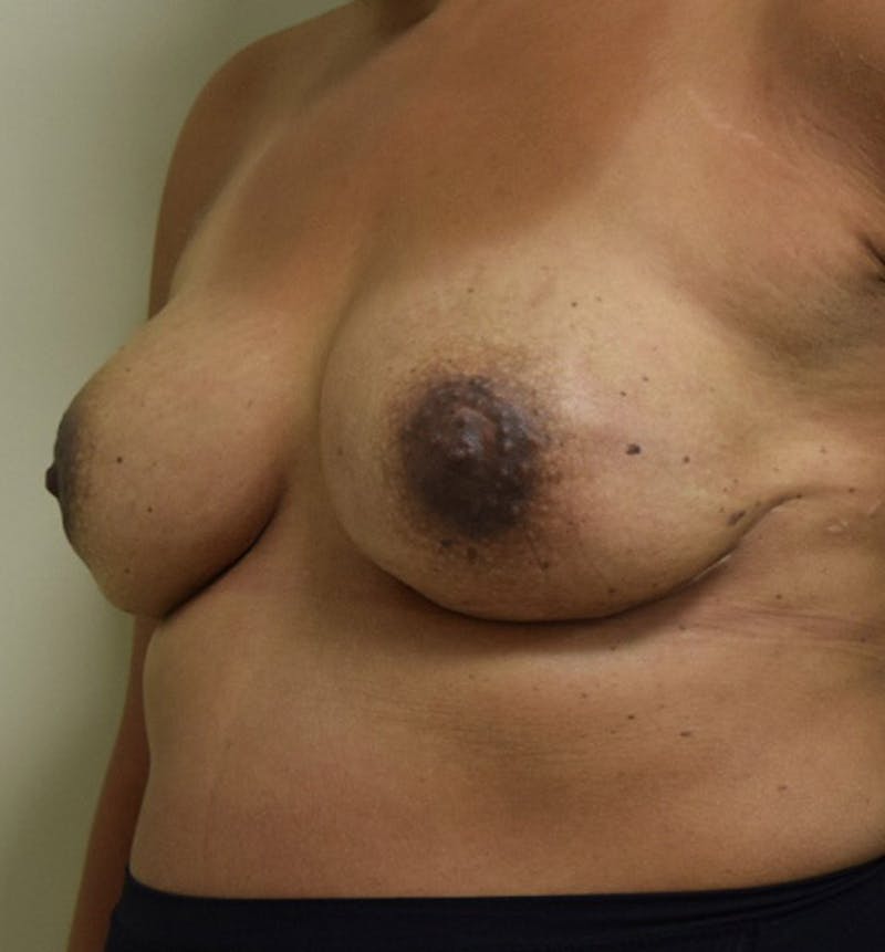 Breast Reconstruction Gallery - Patient 102567034 - Image 8