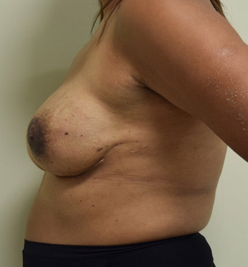 Breast Reconstruction Before & After Gallery - Patient 102567034 - Image 10
