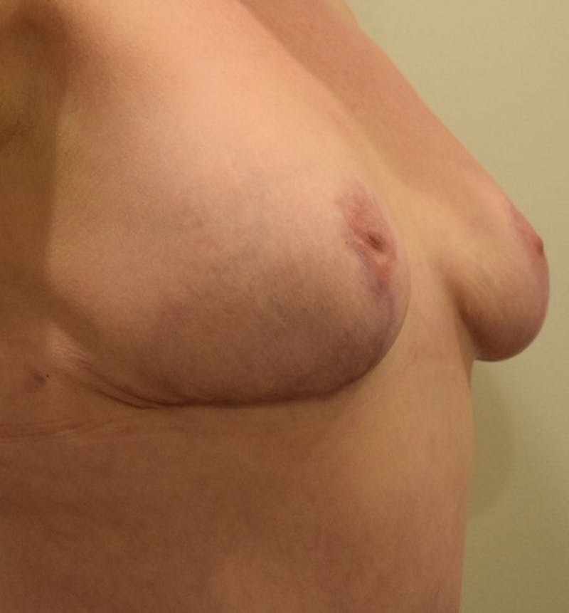 Breast Lift Before & After Gallery - Patient 102567038 - Image 4