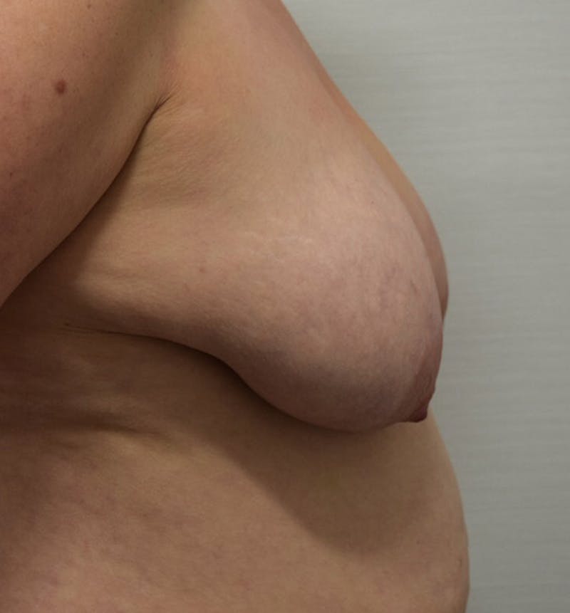 Breast Lift Before & After Gallery - Patient 102567038 - Image 5
