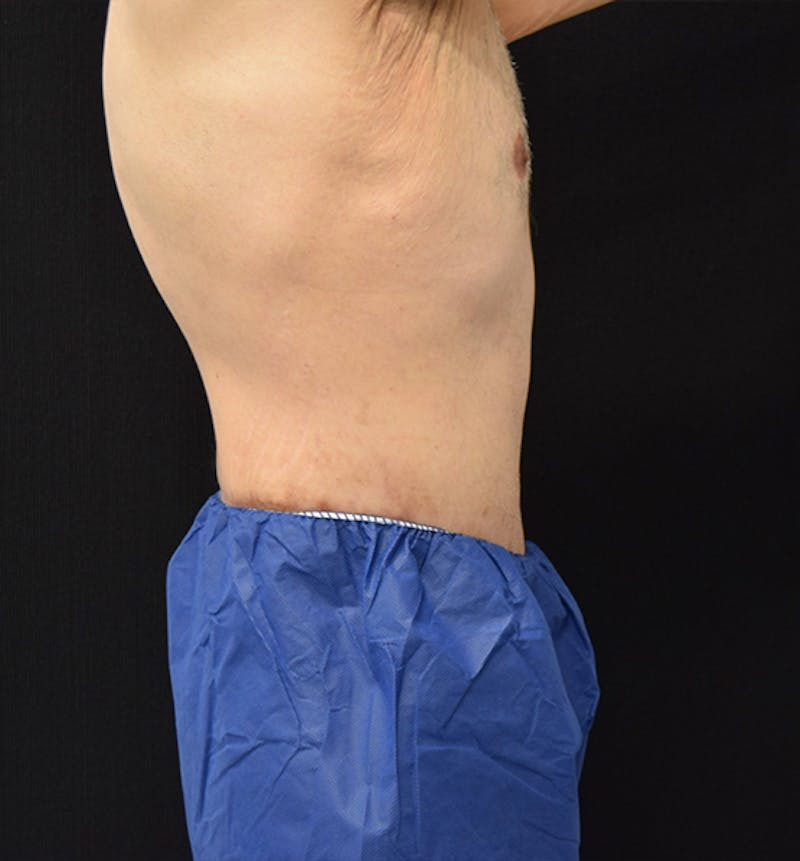 Male Lower Body Lift Before & After Gallery - Patient 148037530 - Image 10