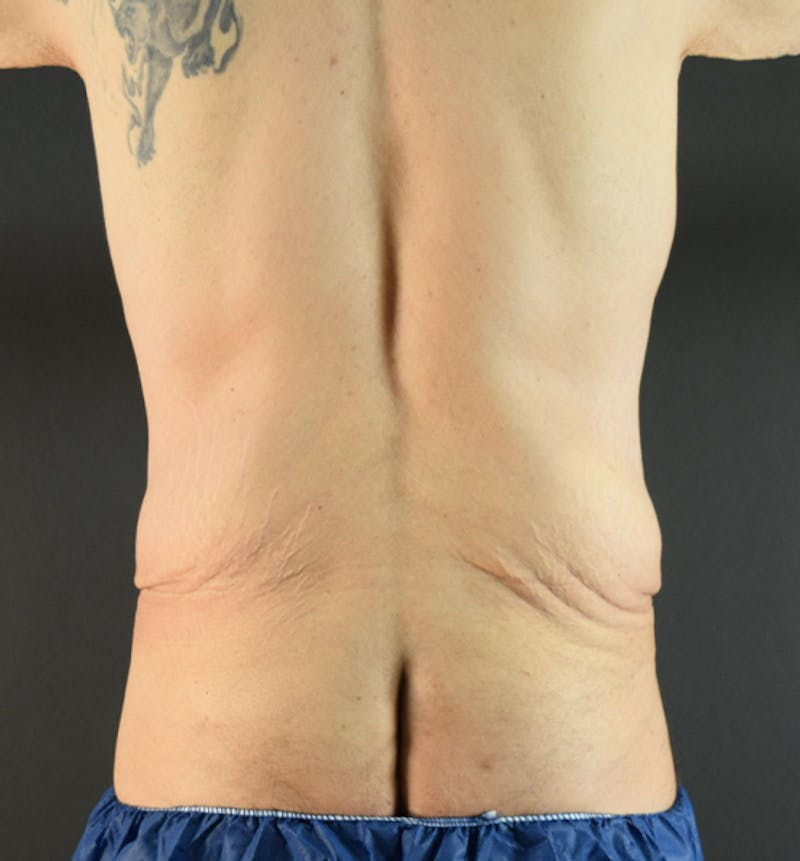 Male Lower Body Lift Before & After Gallery - Patient 148037530 - Image 11