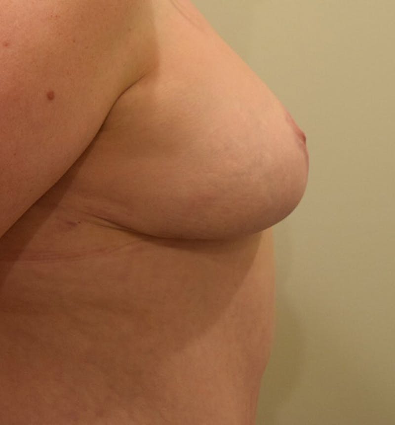 Breast Lift Before & After Gallery - Patient 102567038 - Image 6