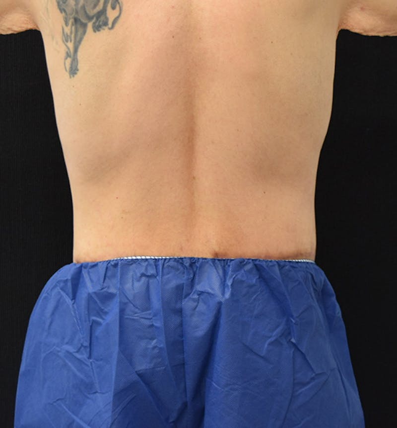 Lower Body Lift Before & After Gallery - Patient 148037530 - Image 12