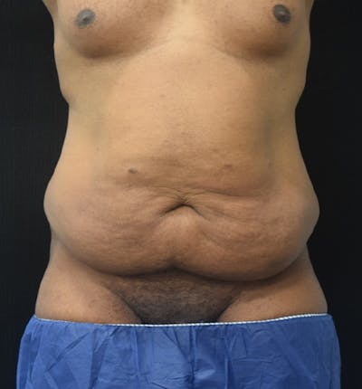 Male Lower Body Lift Before & After Gallery - Patient 148037531 - Image 1