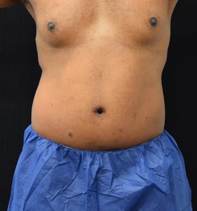 Male Lower Body Lift Before & After Gallery - Patient 148037531 - Image 2