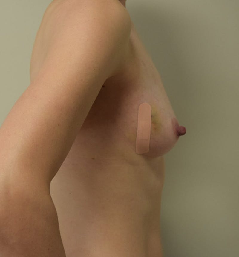 Breast Reconstruction Before & After Gallery - Patient 102567040 - Image 3