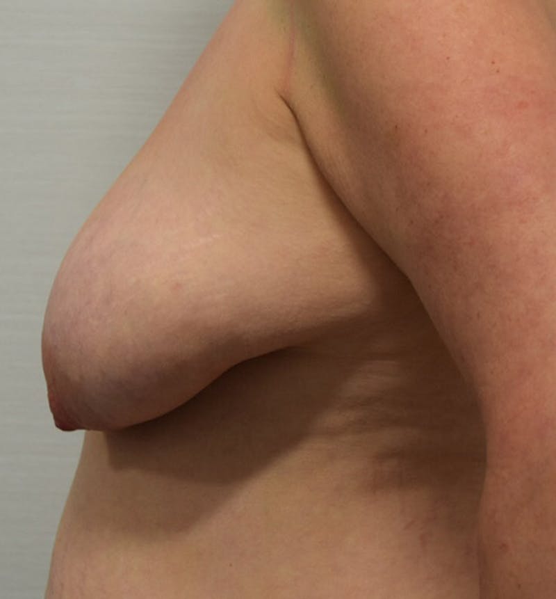 Breast Lift Before & After Gallery - Patient 102567038 - Image 9