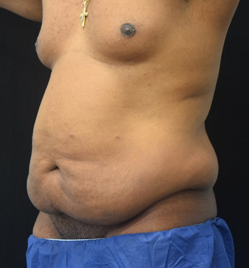 Male Lower Body Lift Before & After Gallery - Patient 148037531 - Image 3