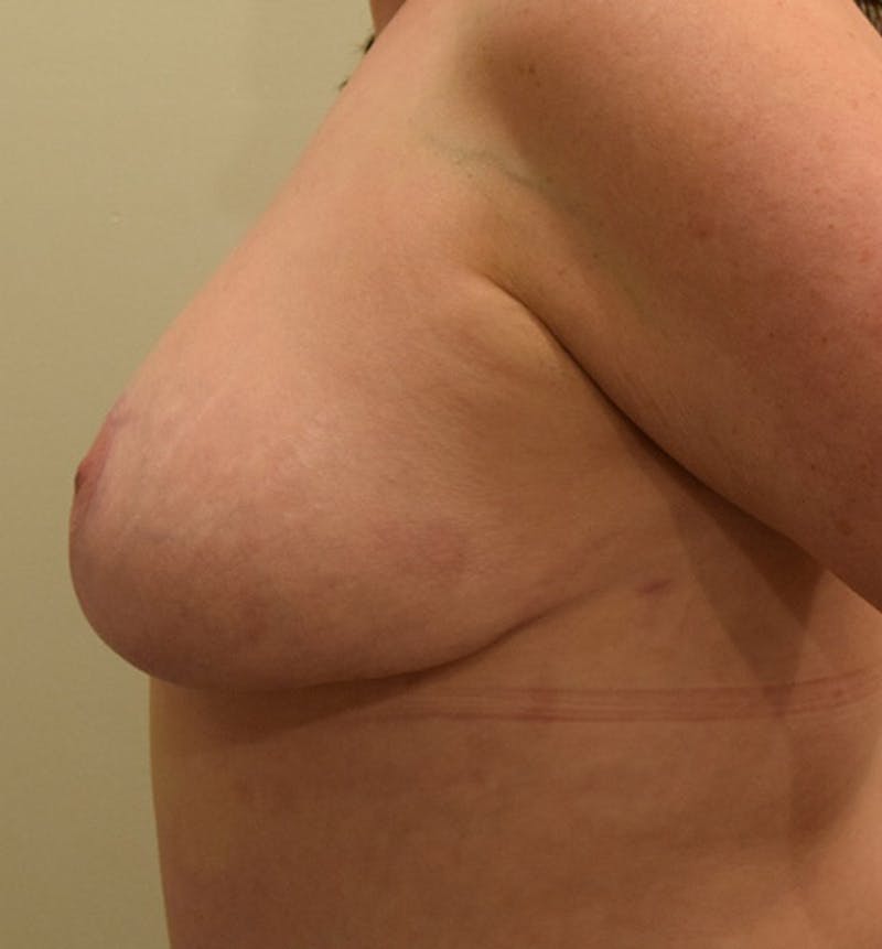 Breast Lift Before & After Gallery - Patient 102567038 - Image 10