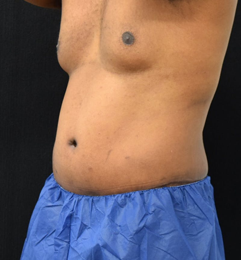 Male Lower Body Lift Before & After Gallery - Patient 148037531 - Image 4