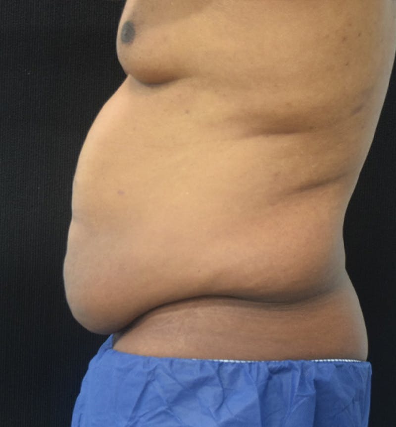Male Lower Body Lift Before & After Gallery - Patient 148037531 - Image 5