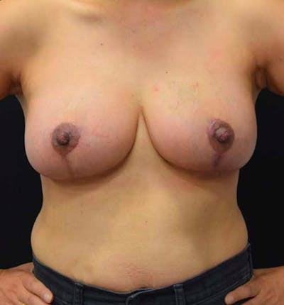 Breast Lift Before & After Gallery - Patient 102567073 - Image 2