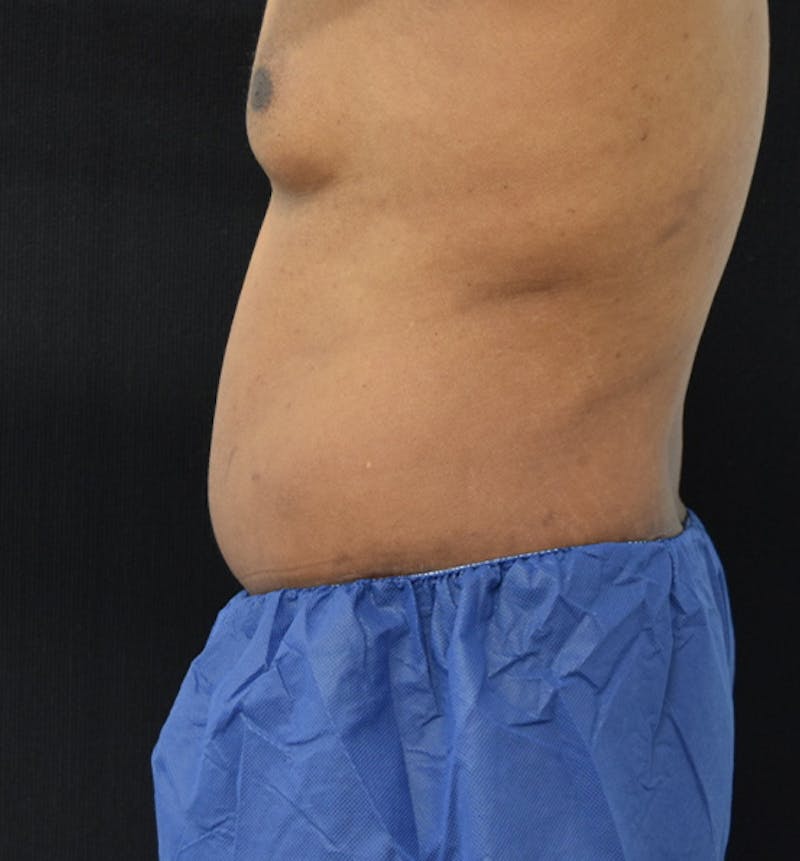 Male Lower Body Lift Before & After Gallery - Patient 148037531 - Image 6