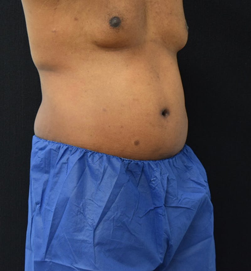 Male Lower Body Lift Before & After Gallery - Patient 148037531 - Image 8