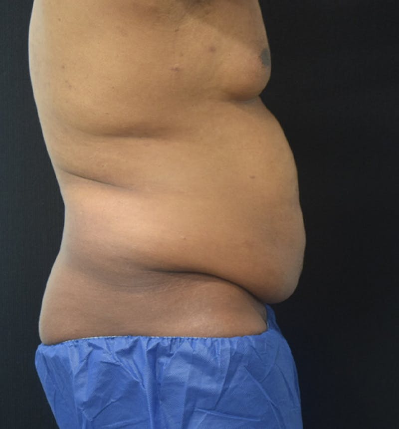 Male Lower Body Lift Before & After Gallery - Patient 148037531 - Image 9