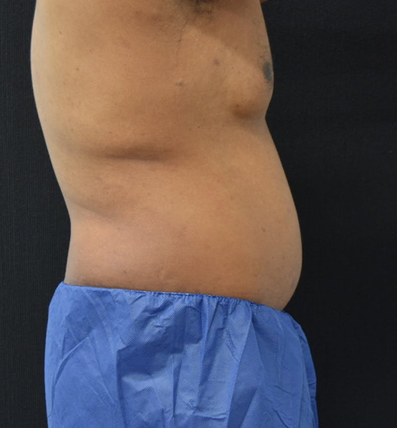 Male Lower Body Lift Before & After Gallery - Patient 148037531 - Image 10