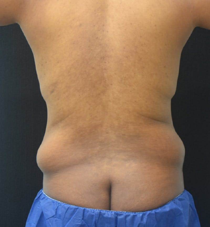 Male Lower Body Lift Before & After Gallery - Patient 148037531 - Image 11