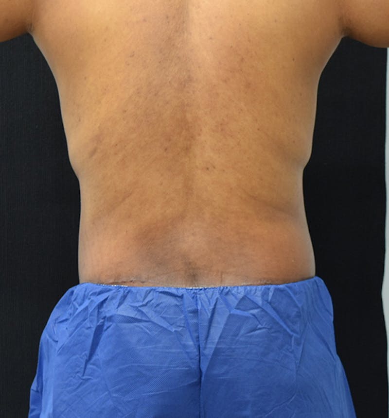 Male Lower Body Lift Before & After Gallery - Patient 148037531 - Image 12