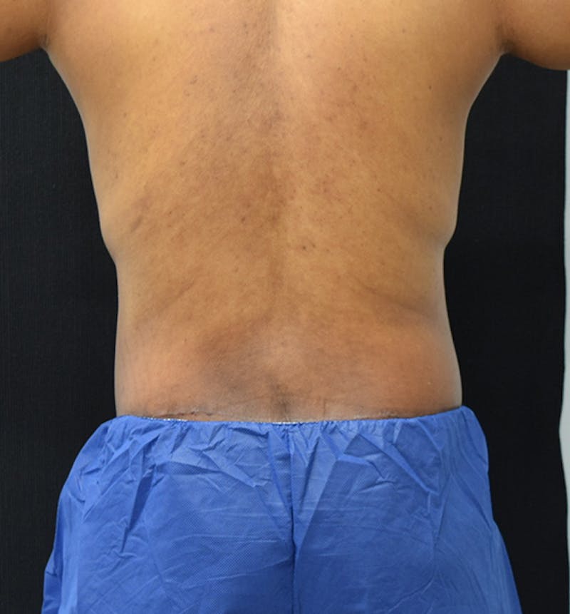 Lower Body Lift Before & After Gallery - Patient 148037531 - Image 12