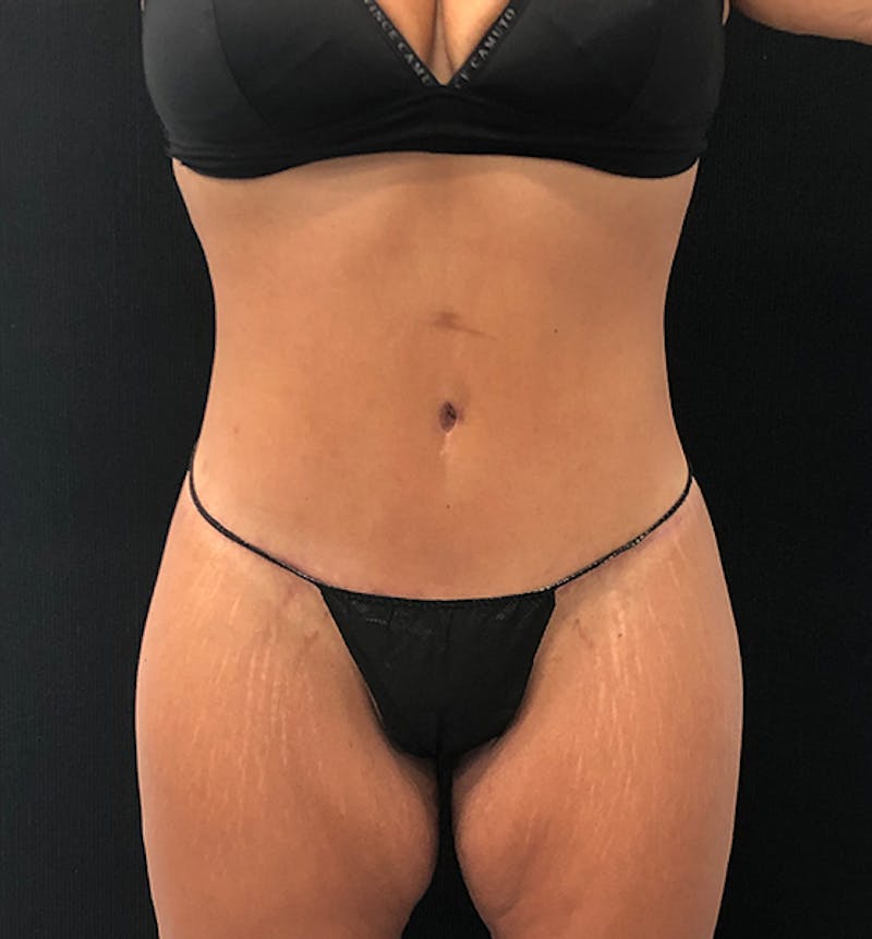 Lower Body Lift Before & After Gallery - Patient 102567147 - Image 2