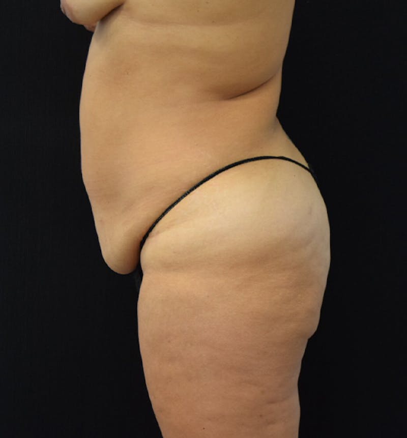 Lower Body Lift Before & After Gallery - Patient 102567147 - Image 5