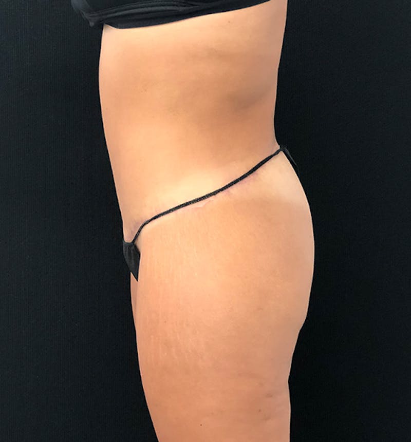 Lower Body Lift Before & After Gallery - Patient 102567147 - Image 6