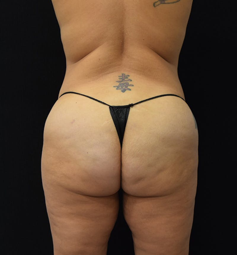 Lower Body Lift Before & After Gallery - Patient 102567147 - Image 7