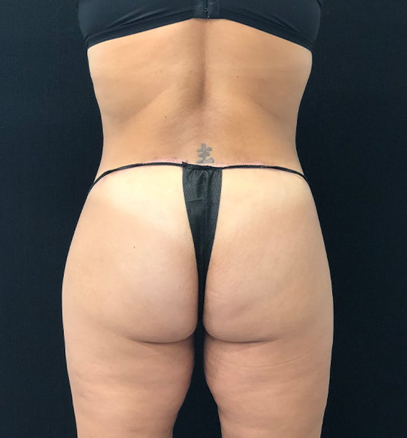 Lower Body Lift Before & After Gallery - Patient 102567147 - Image 8