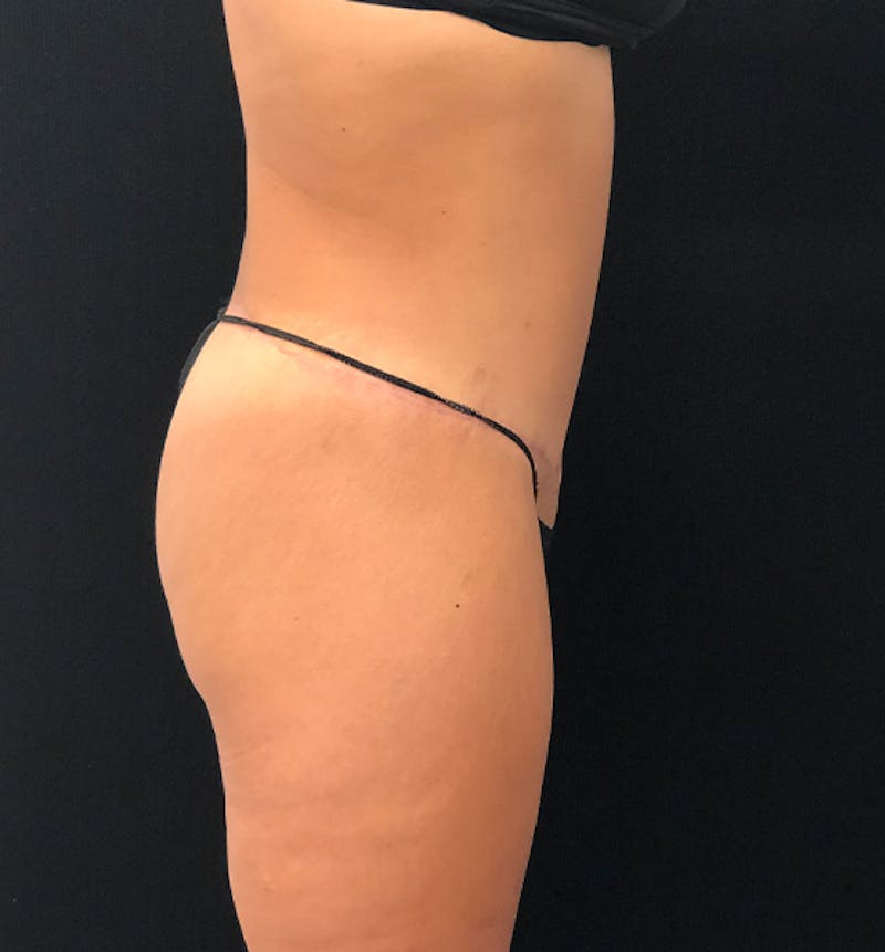 Lower Body Lift Before & After Gallery - Patient 102567147 - Image 10