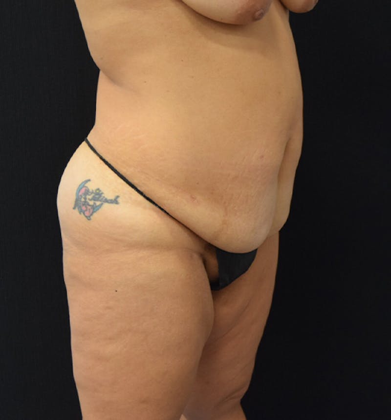 Lower Body Lift Gallery - Patient 102567147 - Image 11
