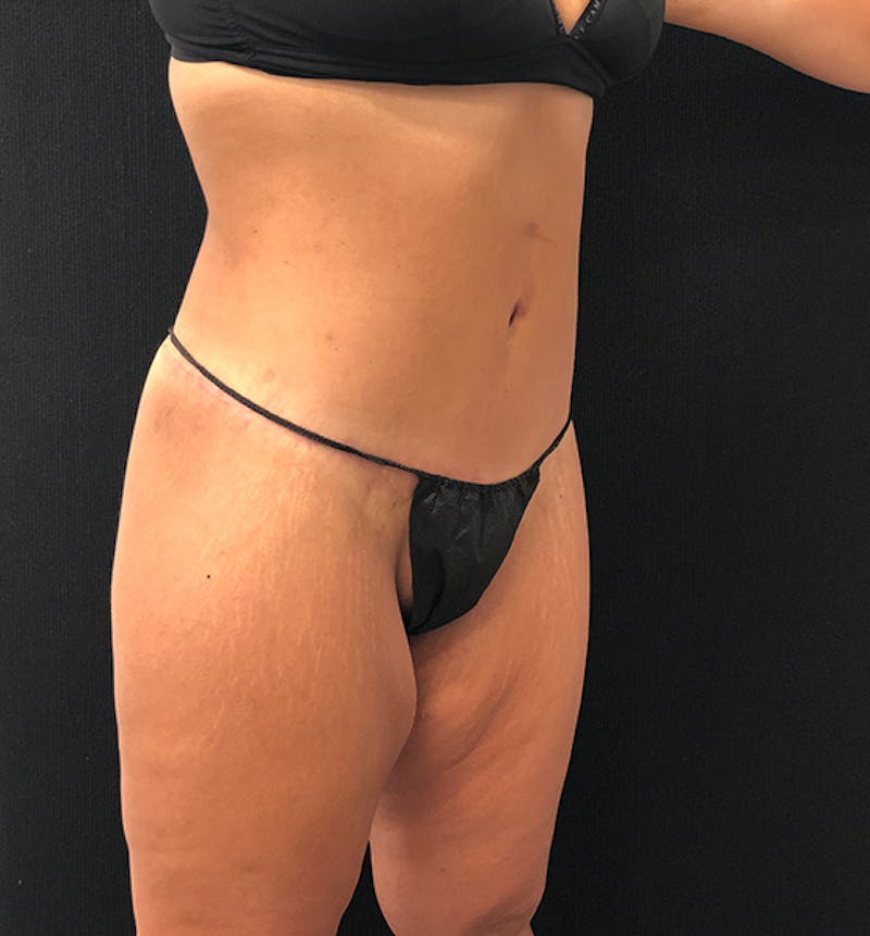 Lower Body Lift Before & After Gallery - Patient 102567147 - Image 12