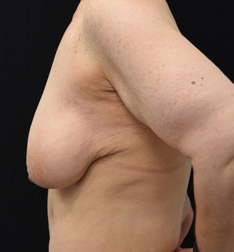 Breast Lift Before & After Gallery - Patient 102567148 - Image 5