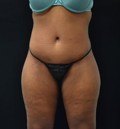 Lower Body Lift Before & After Gallery - Patient 102567166 - Image 2