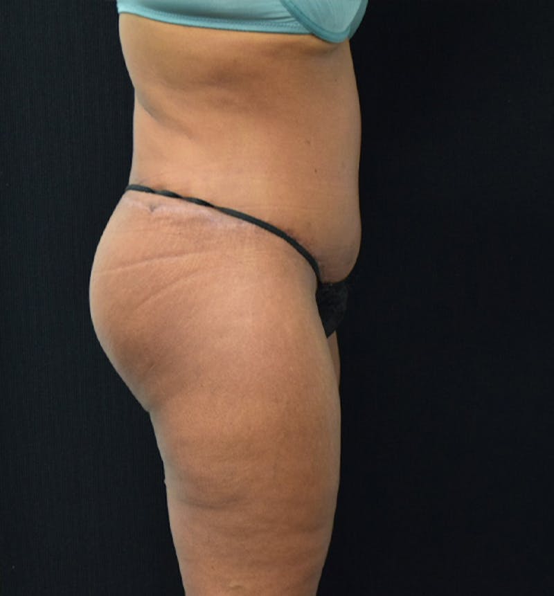 Lower Body Lift Before & After Gallery - Patient 102567166 - Image 4