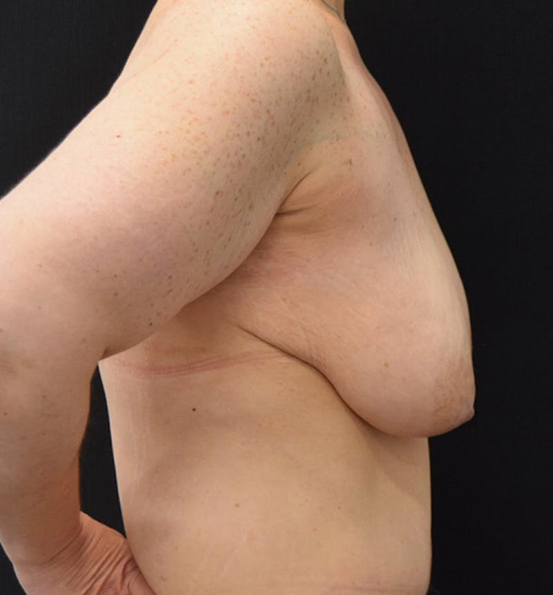 Breast Lift Before & After Gallery - Patient 102567148 - Image 9