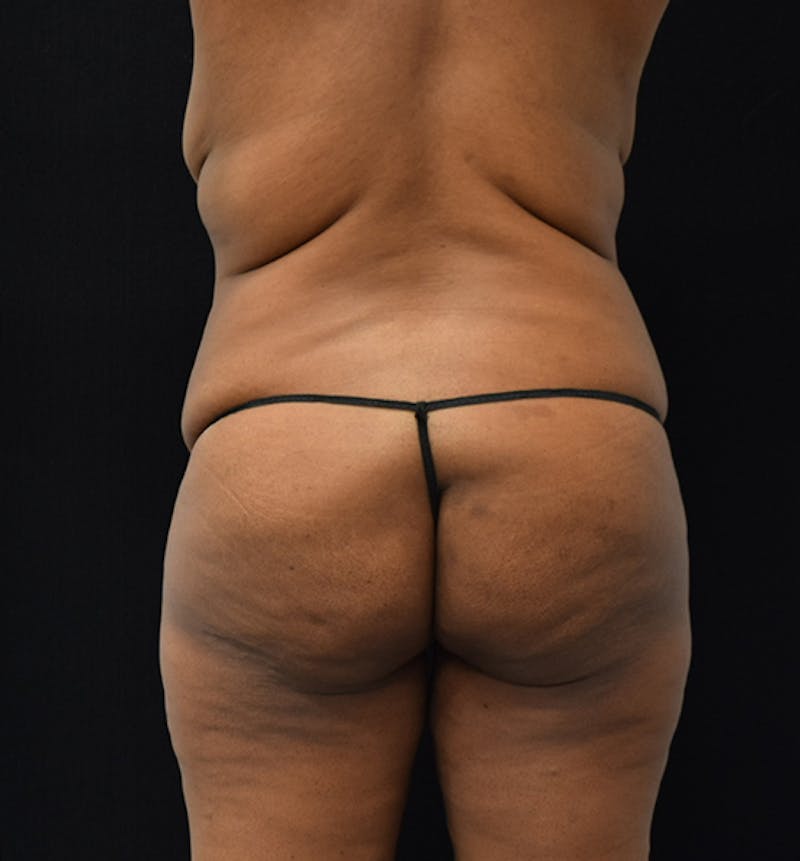 Lower Body Lift Before & After Gallery - Patient 102567166 - Image 5