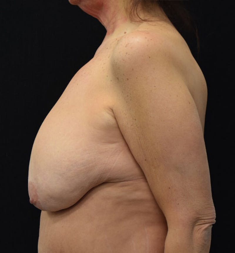 Breast Lift Gallery - Patient 102567168 - Image 5